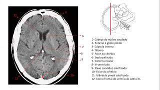 Encéfalo por imagens de tomografia [upl. by Alaik962]