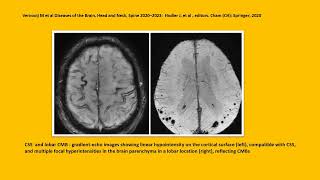 NEUROLOGY QUIZ 69 Cerebral Amyloid Angiopathy CAA [upl. by Refotsirc925]