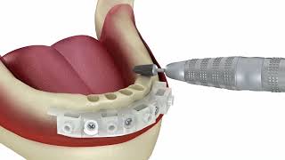 Full Arch Rehabilitation Using Anatomic Guide® Protocol [upl. by Marianne]