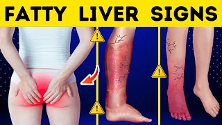 8 Signs You Have A Fatty Liver [upl. by Kristianson]