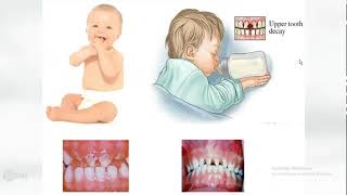 lecture 3 Dental caries with Dr omnya wahba clinical aspects  Classification of dental caries [upl. by Inar]