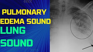 Pulmonary Edema Lung Sound Pulmonary Edema Sound Pulmonary Congestion [upl. by Megen]