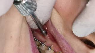 Mini screw mini implant insertion  screwing in orthodontic miniimplant TAD [upl. by Annaihr]