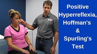 Positive Hoffmans Sign Hyperreflexia and Spurlings Test [upl. by Friedlander565]