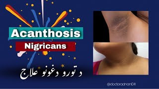 Acanthosis Nigricans Treatment  hyperpigmentation [upl. by Ahseinat270]