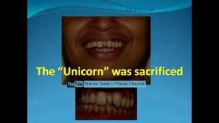 Extra tooth between front teeth  Fixed braces amp no teeth removed [upl. by Ahtiekal164]