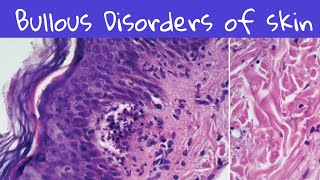 Bullous Disorders of Skin dermatology dermatopathology [upl. by Isaacson]