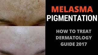 How to treat pigmentation [upl. by Magnusson]