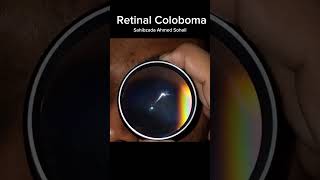 Retinal Coloboma [upl. by Eisteb]