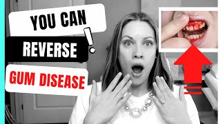 How to Reverse Gum Disease at Home [upl. by Weisbart205]