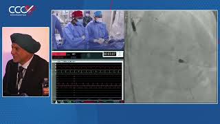 Live Case 1  Impella Supported PCI of Calcified LAD using Rotational Atherectomy and OCT Guidance [upl. by Derte]