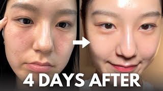 How I repair my skin barrier in 4 days at home with affordable skincare routine [upl. by Oneladgam]