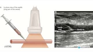 Instructional Series  Sonon Needle Visualization [upl. by Hock791]