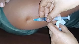 Arm im Injection push Ketorolac Injection videoXerokit 24 Ep47 By Injection Tips [upl. by Ociram]