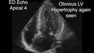 Hypertrophic Obstructive Cardiomyopathy with SAM [upl. by Nomrac916]