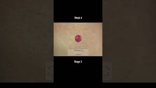 Merkel Cell Carcinoma Development Time Lapse  More Deadly Than Melanoma [upl. by Agustin]