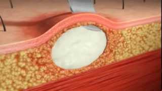 Skin Abscess IampD Animation Injectioncoursescom [upl. by Coats233]