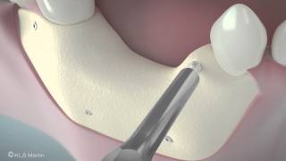 SonicWeld Rx® Dental – Shell technique for vertical defect augmentation [upl. by Nywles]