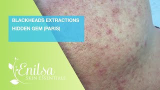 Blackheads Extraction Hidden Gem Paris [upl. by Nosretep]