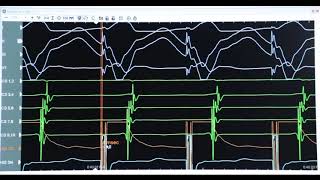 Right Postero Septal Accessory Pathway presented by Dr Anwer Al Zurfi [upl. by Karsten610]