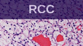 Renal Cell Carcinoma  Pathology mini tutorial [upl. by Siddra296]