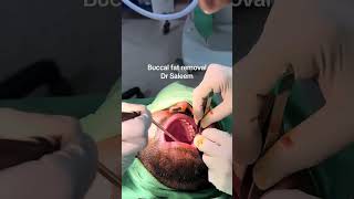 Buccal fat removal in Pakistan lahore [upl. by Notirb]