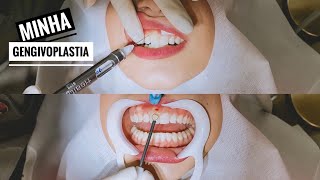 FIZ GENGIVOPLASTIA e o resultado ficou IMPECÁVEL  Vlog [upl. by Iphigenia]