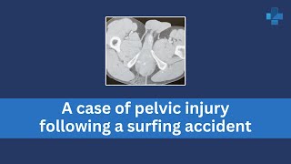 A case of pelvic injury following a surfing accident [upl. by Hammer771]