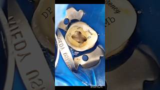 Maxillary second molar with two palatal roots and 4 canals rct shortvideo endodontics [upl. by Adela]