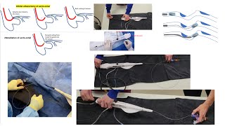 Rotational atherectomy advanced techniques with videos  Orbital atherectomy tips Elias Hanna [upl. by Meir]