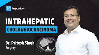 Intrahepatic Cholangiocarcinoma by Dr Pritesh Singh [upl. by Alexandria143]