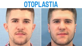 Otoplastia Masculina Antes y Después  Clínicas Diego de León [upl. by Howard864]