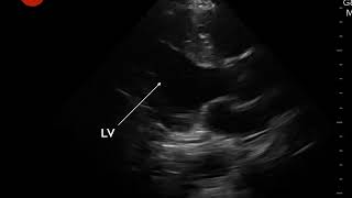 Video 6 Hyperdynamic LV contractility [upl. by Naves]