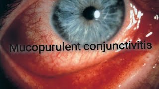 Conjunctiva  Acute bacterial conjunctivitis Part 2 [upl. by Aikenat]