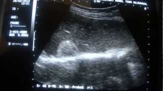 ULTRASOUND LIVER HEMANGIOMAS [upl. by Buff291]