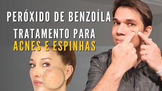 Peróxido de Benzoíla Como usar para acabar com a acne [upl. by Shuman]