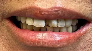 HOW TO DO IVENEER Injectable Composite Veneers [upl. by Lacram151]