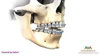 Surgical Orthodontic Treatment for Openbite  Maxillary Impaction [upl. by Neelloc]