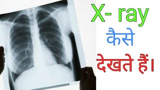 How to read Chest Xray  Hindi language [upl. by Lalad136]