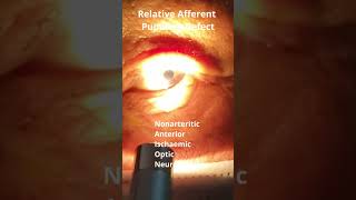 RAPD Relative Afferent Pupillary Defect [upl. by Manya]