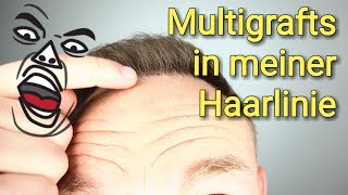 Multigrafts in meiner Haarlinie😱 Haartransplantation Haarausfall [upl. by Leary697]