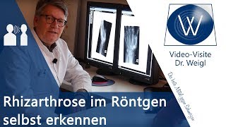 Fingerarthrose amp Daumenarthrose im Röntgen selber erkennen🤓 Diagnostik amp Radiologie Rhizarthrose [upl. by Eneleuqcaj]