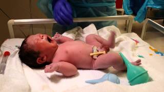 Baby 3 Live Birth in 4K UHD Video Csection Operation Delivery camera recording [upl. by Attirehs]