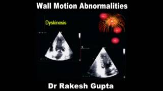 Wall Motion Abnormalities Dr Rakesh Gupta [upl. by Euqinna84]