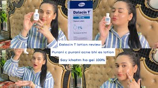 Dalacin T Lotion Review Bye bye Acne 😡 say Hi to new skin❤️Best Acne lotion 100 guaranteed results [upl. by Aliehc813]