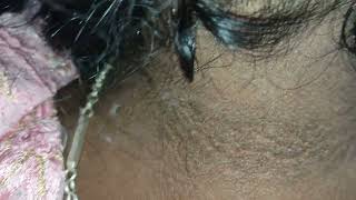 what are disease associated with acanthosis nigricans [upl. by Aseeral]