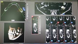 CBCT mandible or cone beam ct xray explained in 10 minutes [upl. by Yer432]