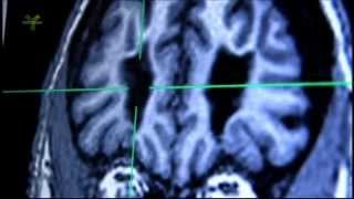 Transorbit lobotomy and MRI examination of living lobotomized patients brain [upl. by Sairacaz852]