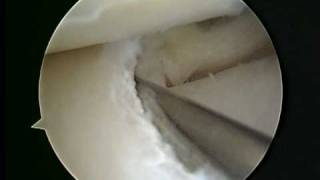 Meniscus cyst decompression [upl. by Gualtiero423]