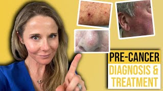 Actinic keratosis treatment guide from a Dermatologist [upl. by Sera]